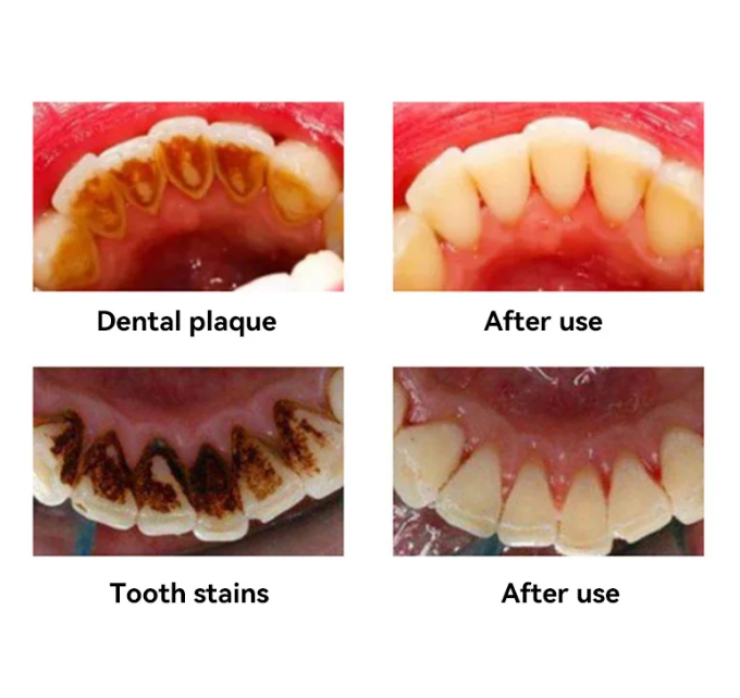 FEELBETTR Oral Plaque & Tartar Remover