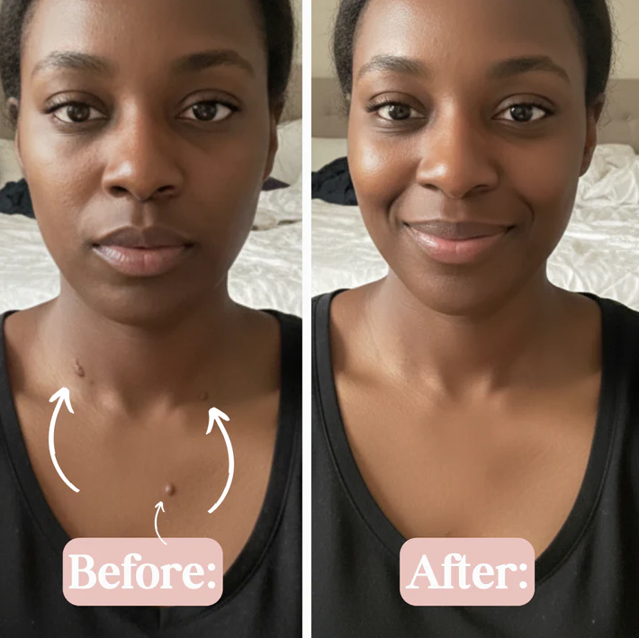 SKIN TAG REMOVER PEN