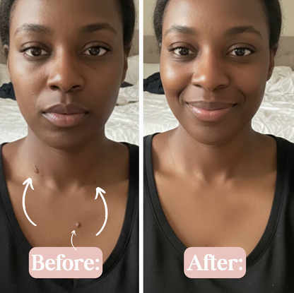 SKIN TAG REMOVER PEN